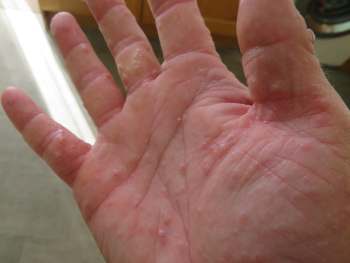 Pompholyx Eczema